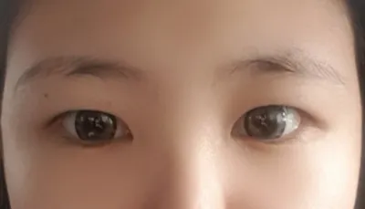 Cắt mí mắt 4 tháng rồi nè