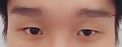 Sửa mắt 2 mí không cắt, mở góc mắt trước 2 tuần..