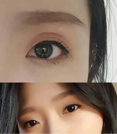 Review 6 tháng sau cắt mí mắt + mở góc mắt trước + cấy mỡ mí trên