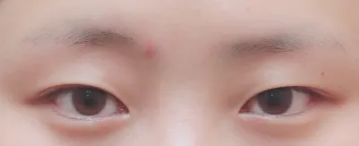 Sửa mắt một tháng rồi ^^