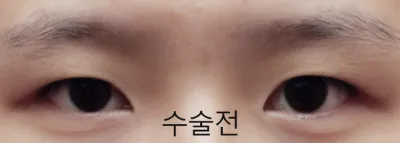 Review thật lòng về cắt mí mắt + mở góc mắt trước, sau và dưới!!