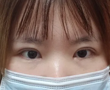 Review cắt mí lại, cắt góc mắt trước sau khi tháo chỉ