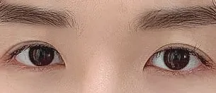 Mắt hai mí bị sưng như xúc xích, cảm ơn bác sĩ Choi Dong-il rất nhiều ạ