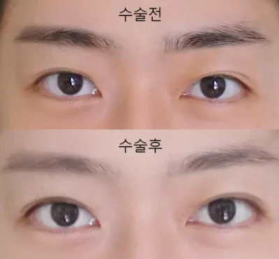 Làm mí mắt chôn