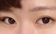 Mình đã làm mắt 2 mí (không rạch) + mở góc mắt trước được 1 tháng rồi nè!!!!