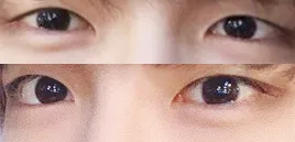 Review về cắt mí mắt cho nam không mí lót, mở góc mắt trước