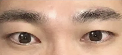 Chỉnh sửa mắt một mí cho nam