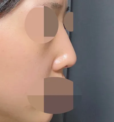 Mình đã phẫu thuật mũi chức năng bằng phương pháp chỉnh hình vách ngăn và cắt bỏ cuốn mũi dưới!