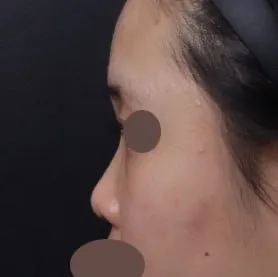 Mọi người hãy nâng mũi ở Thẩm mỹ viện Very Good nhé!