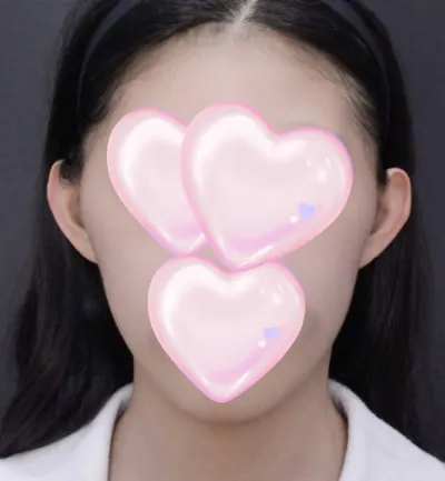 Mình đã thực hiện hạ gò má, thu gọn đầu cằm và trượt cằm bằng tiền túi của mình~