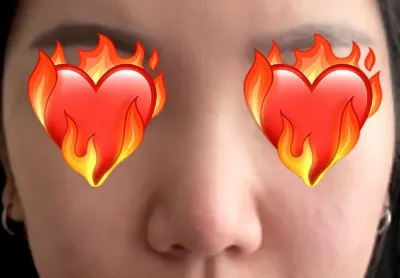 Vì lo lắng về dáng mũi lân nên mình đã phẫu thuật thẩm mỹ mũi tại Very Good.