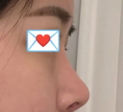 Mình đã phẫu thuật lại mũi với Viện trưởng Lim Young-min tại Thẩm mỹ viện Very Good!