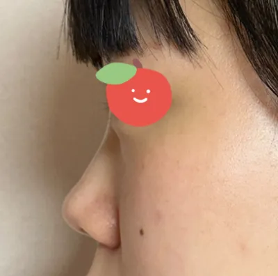 Mình đã đi hơn 7 nơi khám mũi chức năng nhưng đều bị từ chối, vậy mà ở thẩm mỹ viện Very Good họ nói có thể xử lý được cả viêm xoang và giải thích rất kỹ nên mình đã ký hợp đồng.