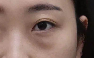 Vì là phẫu thuật lại nên mình đã đi tìm hiểu khắp nơi một cách thận trọng hơn, nhưng nhờ Trưởng phòng Choi Hyun-jung và Viện trưởng Kim Yong-woo giải thích rất kỹ lưỡng cũng như tạo cảm giác thoải mái nên mình đã quyết định chọn nơi này.