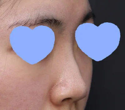 Ngay lần đầu đi tư vấn mình đã ưng quá nên chốt luôn lịch phẫu thuật và đặt cọc luôn rồi..^^