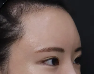 Vào ngày phẫu thuật mình hơi đau một chút nhưng vì có hiệu quả nên mình thấy rất vui! Khoảng cách giữa mắt và lông mày cũng rộng ra và trán thì thu nhỏ lại rồi~^^