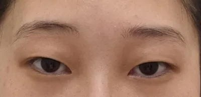 Những bạn đang cân nhắc cắt mí thì đừng đi nhiều nơi mà hãy đến Thẩm mỹ viện Very Good để mình tư vấn cho nhé (ⓐⓐ) °◇°