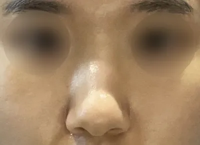 Hiện tại đã 2 tháng sau khi phẫu thuật, mình rất hài lòng và vì không có bất kỳ tác dụng phụ nào nên mình đang sinh hoạt rất tốt.