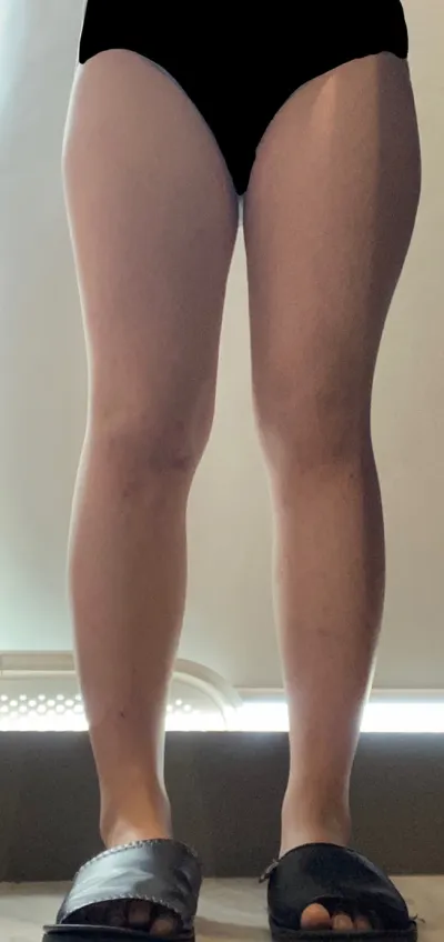 Mình đã thử rất nhiều phương pháp giảm cân nhưng lần nào cũng chỉ có mỡ đùi là không giảm nên mình đã bị stress rất nhiều. Hút mỡ chính là câu trả lời..