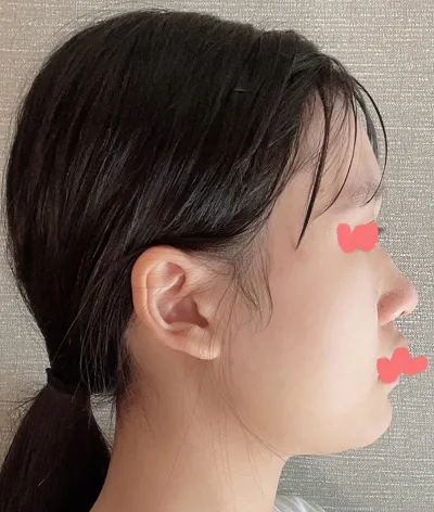 Mình rất hài lòng và sự tự tin của mình cũng tăng lên hẳn. Những ai đang phân vân về việc nâng mũi thì mình nghĩ cứ làm đi là tốt nhất.