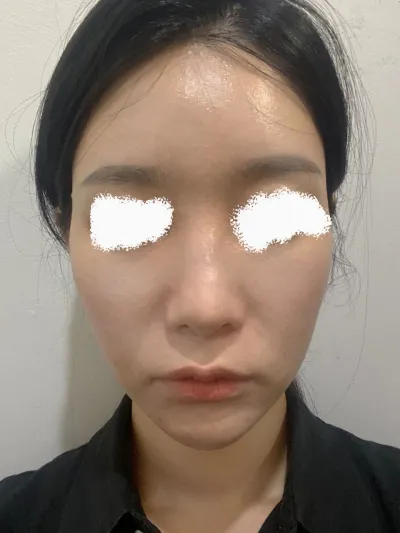 Vì mình đã thực hiện phẫu thuật gọt hàm đường dài từ bác sĩ vào năm ngoái và cảm thấy hài lòng nên