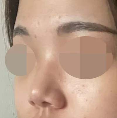 Vì mình rất bận tâm về chiếc mũi ngắn và sống mũi thấp nên mình đã quyết định phẫu thuật!