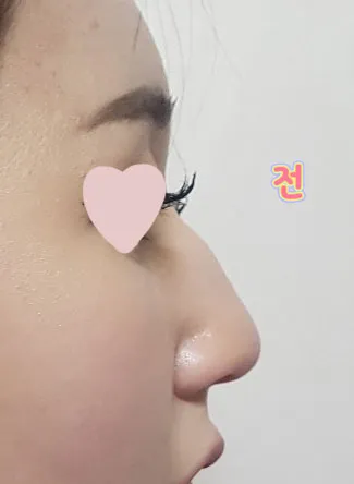 Mọi người xung quanh ai cũng khen mũi mình làm đẹp lắm.