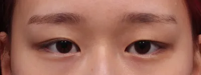 Bên trong bệnh viện sạch sẽ và mọi người đều thân thiện nên mình đã thực hiện từ tư vấn, phẫu thuật đến chăm sóc hậu phẫu một cách thoải mái.