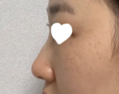 Nhân tiện phẫu thuật viêm mũi, mình đã chỉnh lại phần mũi gồ và tiến hành phẫu thuật nâng mũi cùng lúc.