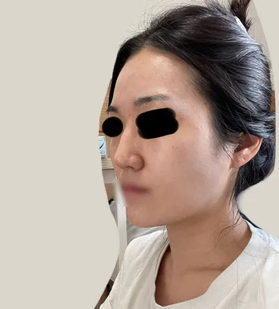 Mình đã làm thủ thuật được 5 tháng rồi.