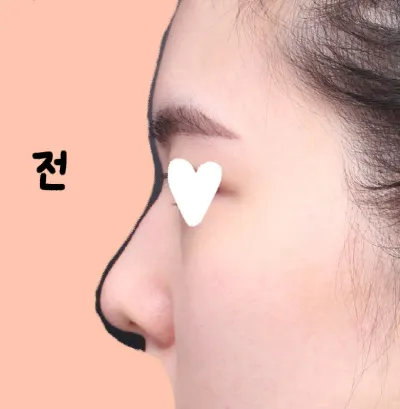 ll use "Nếu mọi người..."? No, "mọi người" is not "mình".

    *   Okay, the translation is:
    *   Nếu đang cân nhắc phẫu thuật ở BerryGood thì đừng chần chừ mà hãy làm đi!!!!

    *   Wait, "고민" can also be "băn khoăn".
    *   "Nếu đang băn khoăn về việc phẫu thuật ở BerryGood thì đừng chần chừ mà hãy làm đi!!!!"

    *   "Cân nhắc" is fine.

    *   Let's double check the "mình" instruction. "For first-person pronouns, always use 'mình'". This is a common instruction for AI to ensure a specific tone (friendly