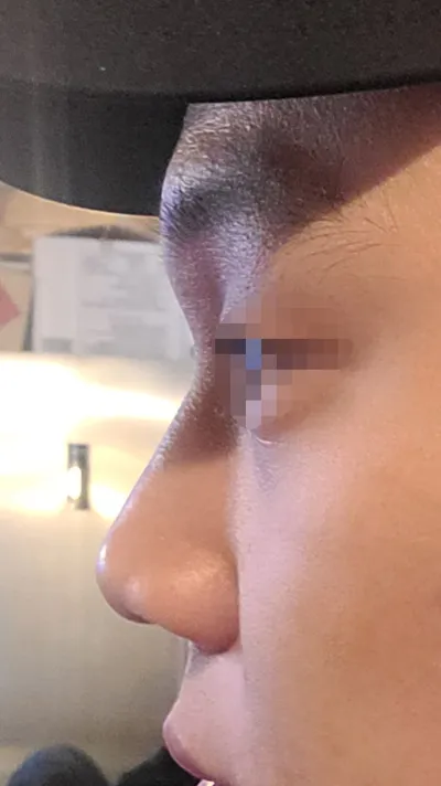 Bác sĩ làm mũi nam rất đẹp. Mình đề xuất Thẩm mỹ viện Very Good.