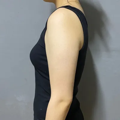 Review hút mỡ bắp tay sau nửa năm của mình!