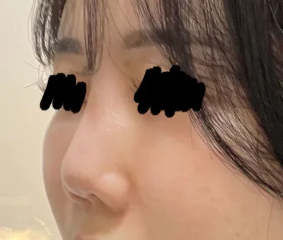 Kết quả phẫu thuật mình thực sự rất hài lòng. Bác sĩ có bàn tay vàng.. ^^*