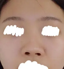 Lần đầu phẫu thuật mũi của mình bị hỏng nên mũi bị vẹo, thấp và lỗ mũi không đều, đúng là một mớ hỗn độn...