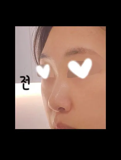 Mình đang bước sang tháng thứ 4 sau khi phẫu thuật nâng mũi chức năng ㅎㅎ