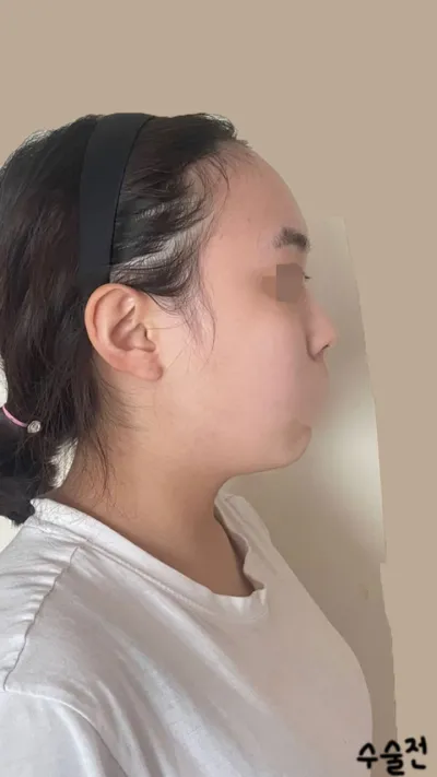 Đây là bài review sau 3 tháng phẫu thuật của mình!