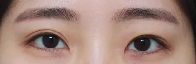 Review phẫu thuật thẩm mỹ mắt (tái phẫu thuật) tháng thứ 3 của mình,,,