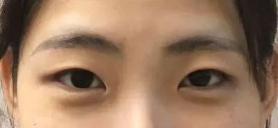 Vào ngày 20 tháng 4 năm nay, mình đã thực hiện phẫu thuật thẩm mỹ mắt (lần đầu) bằng phương pháp nhấn mí (liên kết tự nhiên) và chỉnh hình mắt không cắt rạch.