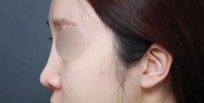 Cảm giác như mới hôm kia mình còn đi tìm hiểu về phẫu thuật lại mũi, vậy mà thời gian đã trôi qua nhanh chóng và giờ đã được khoảng 6 tháng rồi.