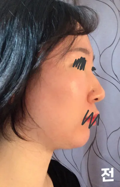 Mình đã thực hiện nâng mũi, mài xương, phẫu thuật cuốn mũi dưới, chỉnh mũi gồ và thu gọn cánh mũi tại Thẩm mỹ viện Very Good. Tính đến nay đã được khoảng 7 tháng rồi!