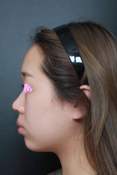 Mình rất thích vì được tư vấn kỹ lưỡng từ lúc tư vấn đến khi phẫu thuật và mọi người rất thân thiện ㅠㅠ