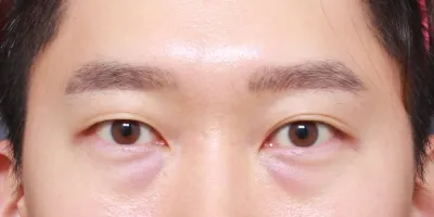 Đây là review tái định vị mỡ dưới mắt cho nam của mình.