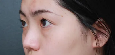 Mình đã thực hiện nâng mũi (mũi đầu), nâng sống mũi, mài xương và tái định vị mỡ dưới mắt tại Bệnh viện thẩm mỹ Very Good!