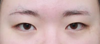 Lần này mình, một người vốn có mắt một mí, đã phẫu thuật thẩm mỹ mắt (lần đầu) rồi ạ..