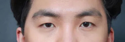 Phẫu thuật thẩm mỹ mắt nam, giờ mình đã tự tin hơn rồi hihi.