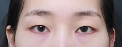 Mình đã phân vân về việc phẫu thuật từ lâu rồi, và mình thấy thật đúng đắn khi đã quyết định làm!