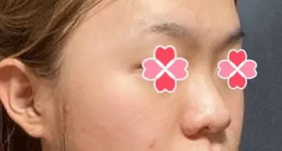 Sau khi phẫu thuật mũi, mình nghe nhiều người nói là ấn tượng tổng thể của mình trở nên tốt hơn.