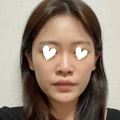 Mình cảm thấy rất vui vì đã thay đổi diện mạo chỉ nhờ phẫu thuật mũi ❤️