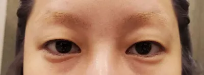 Mình làm nhấn mí tự nhiên được hơn một tháng rồi.